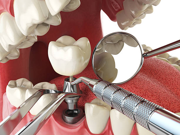 Best Emergency Dental Care for Abscessed Tooth in Fort Shawnee, OH